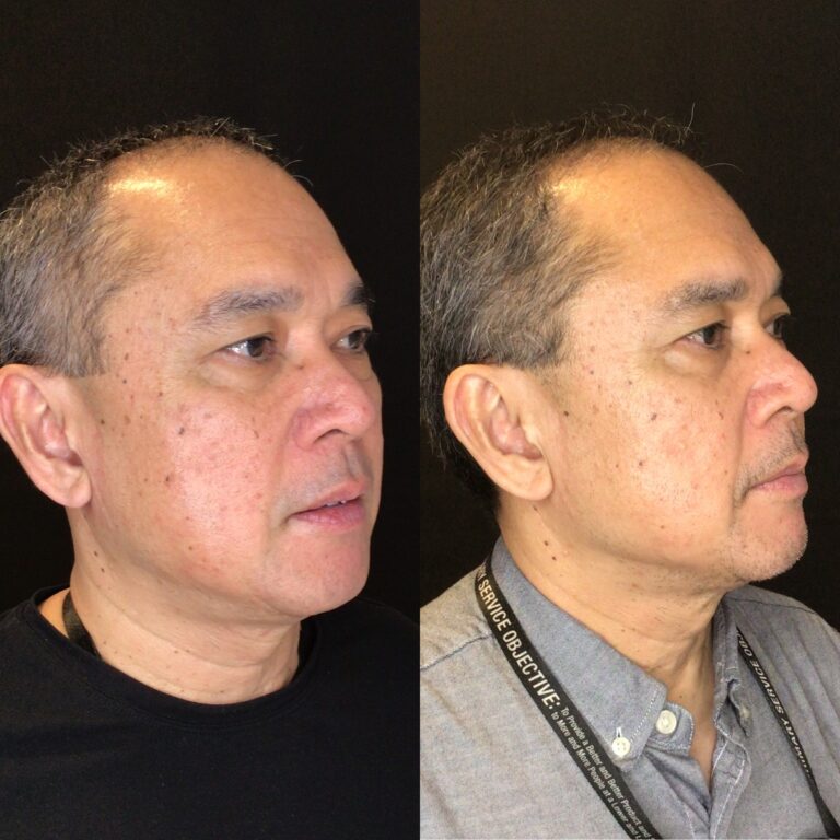 Desert Bloom patient — PRX-T33 result, case 1