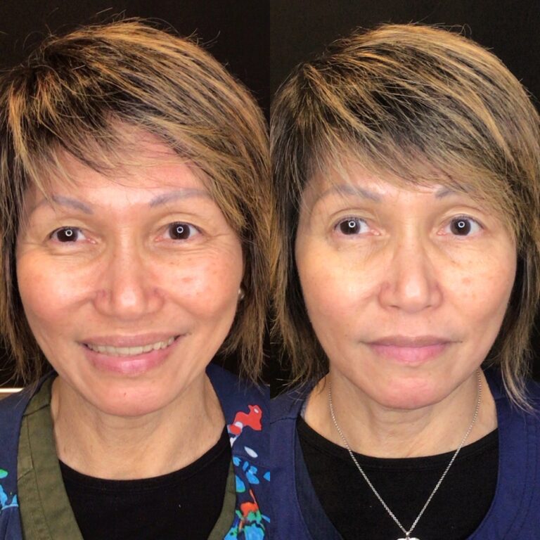 Desert Bloom patient — PRX-T33 result, case 3