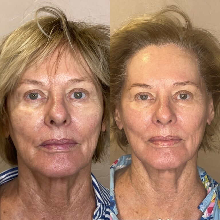 Desert Bloom patient — PRX-T33 result, case 5