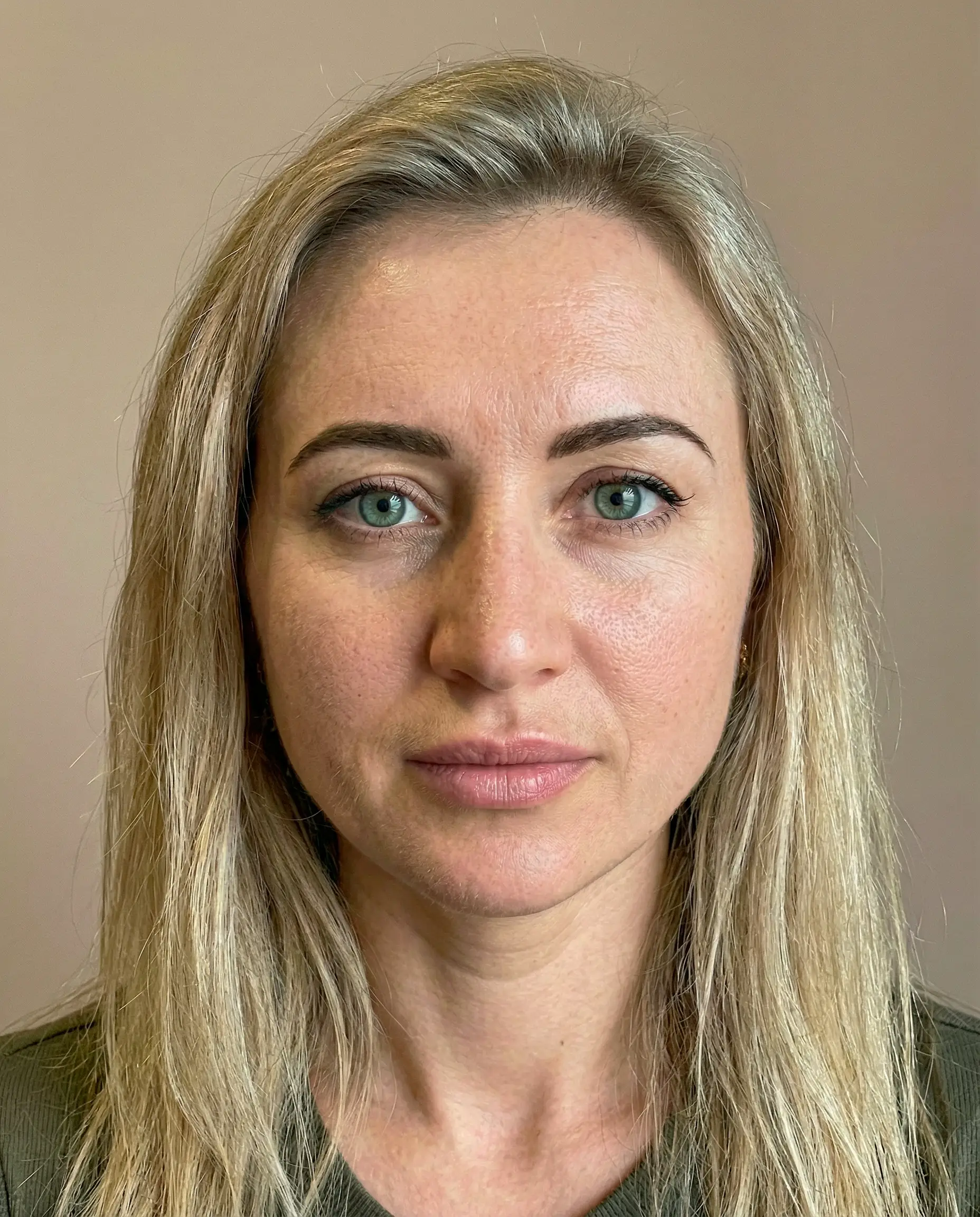 Thread lift case study — 37-year-old female patient at six-month follow-up showing refreshed facial contours after PLLA/PCL absorbable thread treatment — after