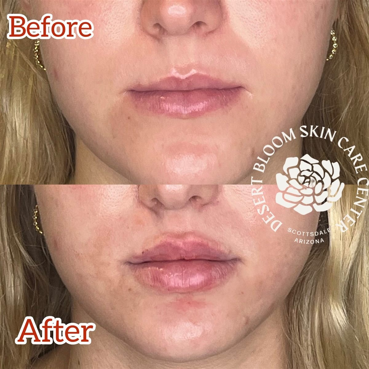 Lip filler with Revanesse Versa before and after at Desert Bloom Skin Care, front view