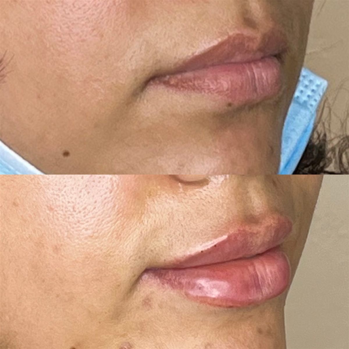 Lip filler with Revanesse Versa before and after at Desert Bloom Skin Care, side view