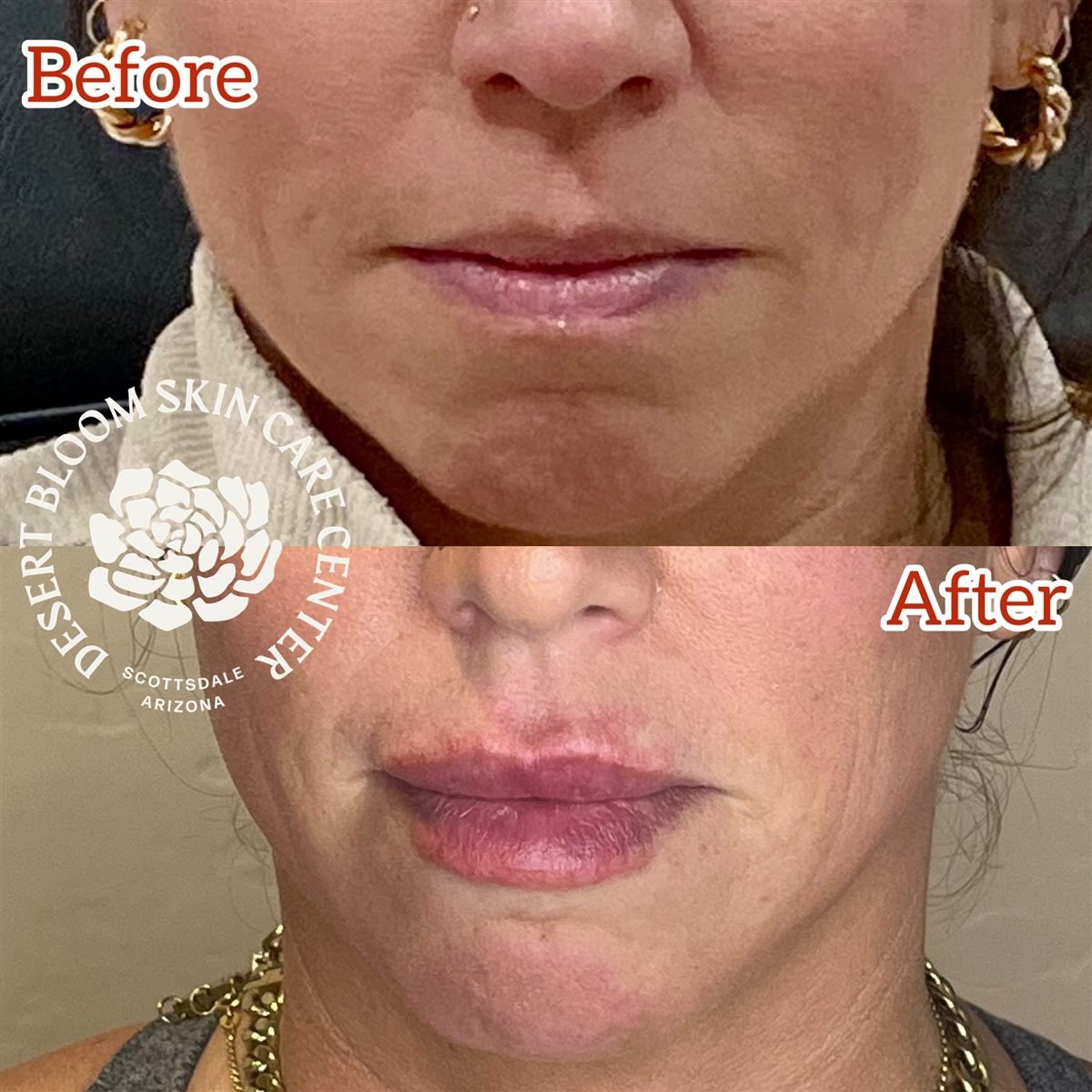 Lip filler with Revanesse Versa before and after at Desert Bloom Skin Care, front view