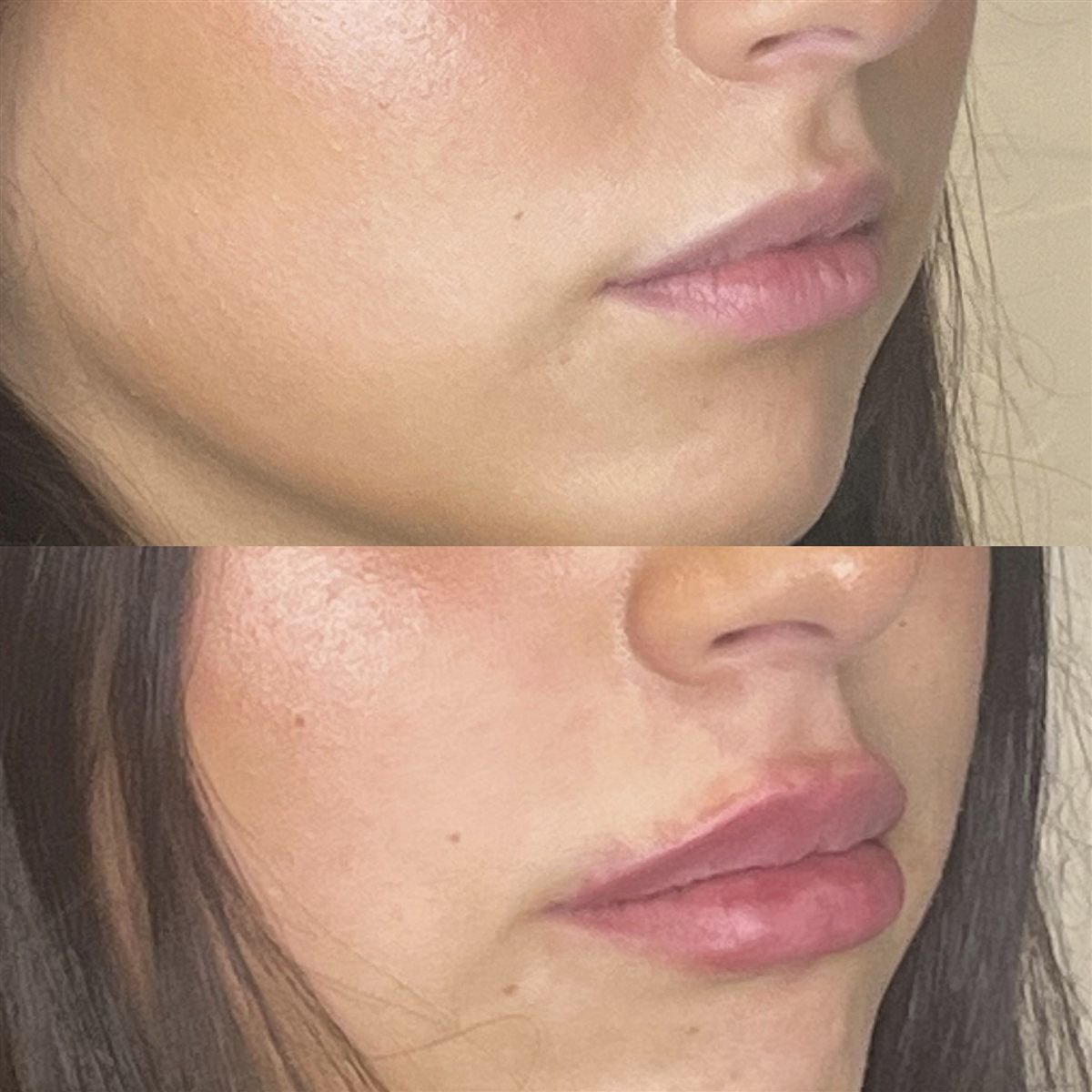 Lip filler with Revanesse Versa before and after at Desert Bloom Skin Care, side view