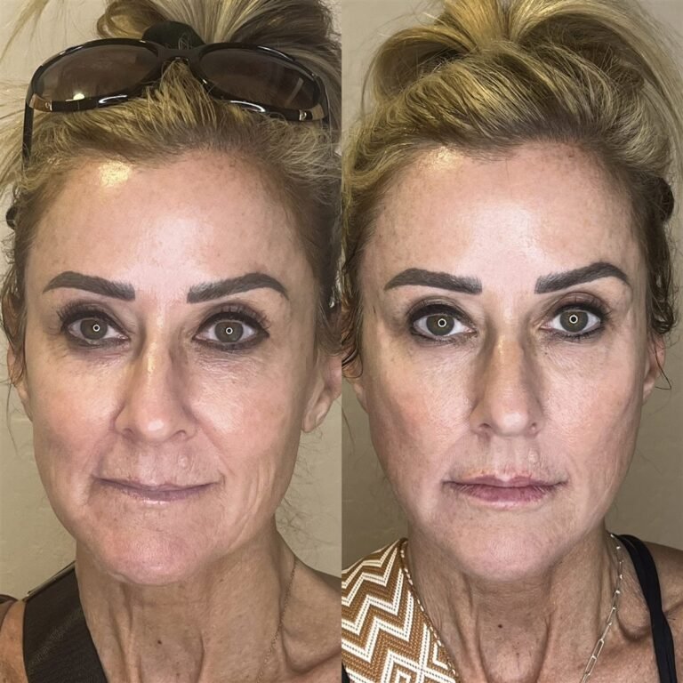 PRX-T33 before and after at Desert Bloom Skin Care, front view